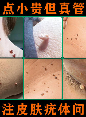 腋下颈部瘊子丝状疣皮赘脖子肉粒肉痣皮肤疣体医用凝胶