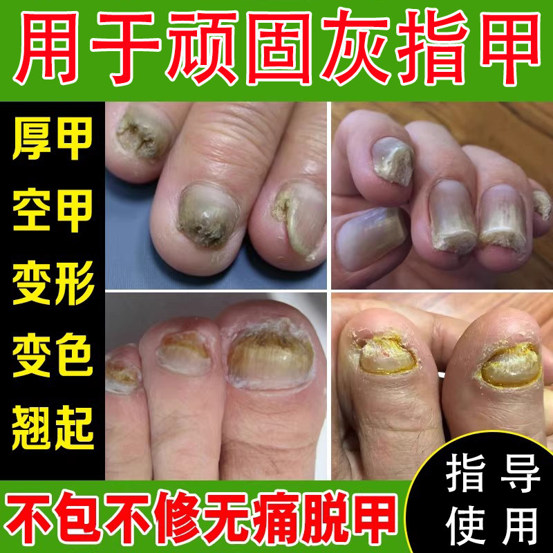 不包不修不痛7天去除增厚坏甲