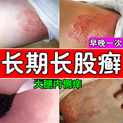 大腿内侧皮肤瘙痒膏汗疱皮炎股癣藓止痒真菌感染专用去屁股根湿疹