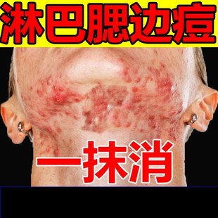 去淋巴痘腮边痘下巴痤疮腮帮子脸颊两边脖子长痘根祛重度暗疮药膏