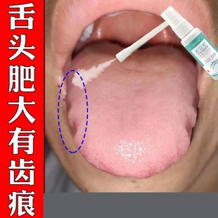 舌头肥大有齿痕专用草本喷剂舌苔白厚裂痕灼痛舌根麻木修复地图舌