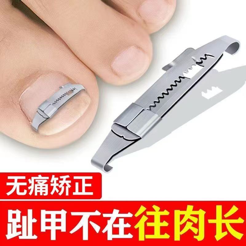 甲沟炎矫正器脚趾甲卷甲