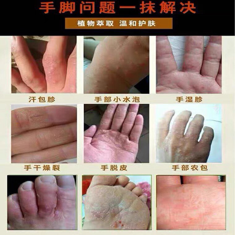 手痒起水泡脱皮干裂百草
