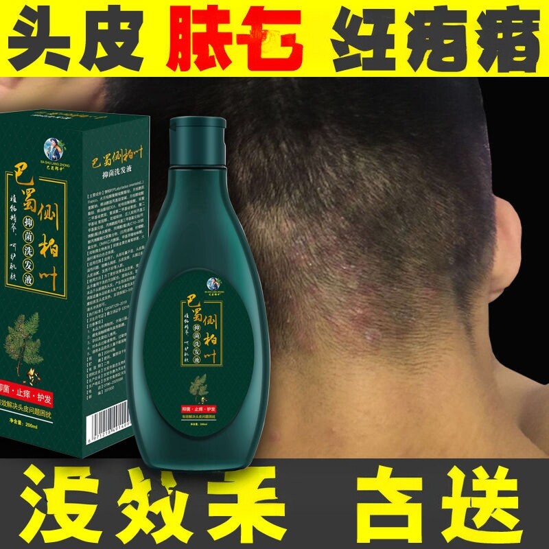 头上长红疙瘩长痘痘痒头皮屑多治