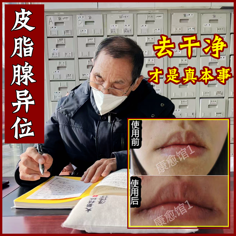皮脂腺异位症嘴角嘴唇白点增生干裂脱皮脂肪小颗粒去除药唇专用膏