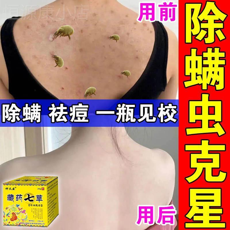 螨虫药膏人用脸上螨虫除螨全身后背除螨杀菌背部止痒专用特效药