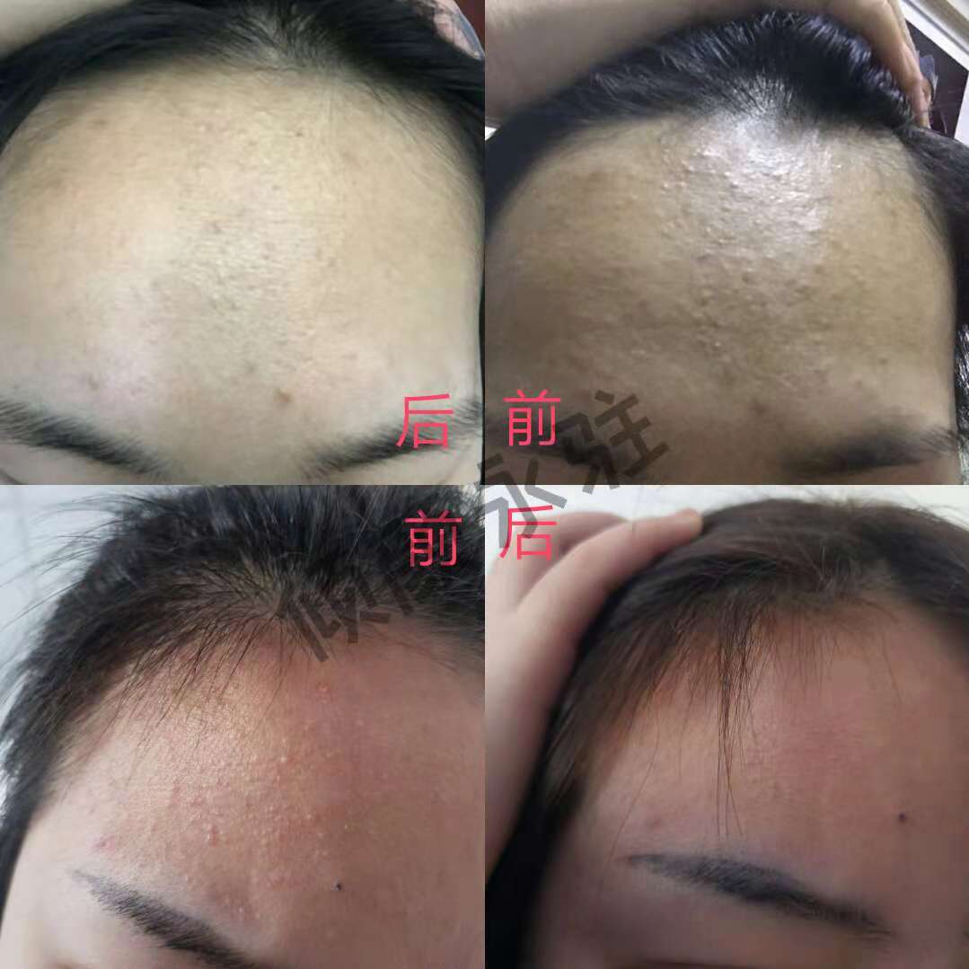 脸上起去闭口粉刺痘痘，粉刺膏，老款，旧款