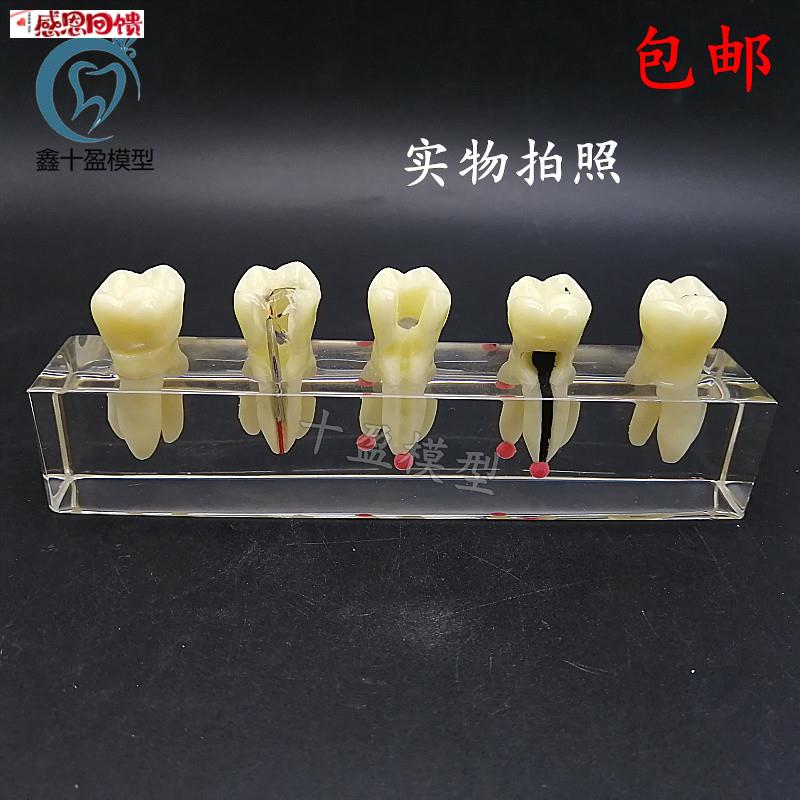 口腔教学模具 水晶根管治疗模型 可拆修复牙冠w 龋齿蛀牙病理M401