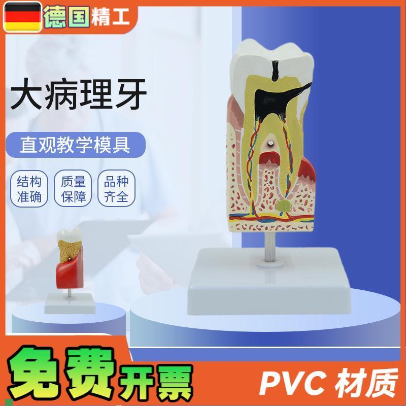 德国】人体大病理牙齿模型蛀牙模E型蛀牙放大牙齿解剖病理牙病