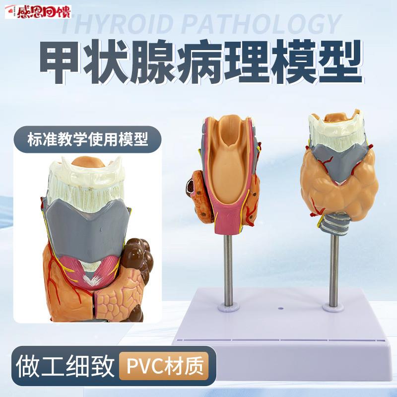 教学仿真人体甲状腺病理模型喉头解剖甲状腺留z甲状腺囊肿标本教