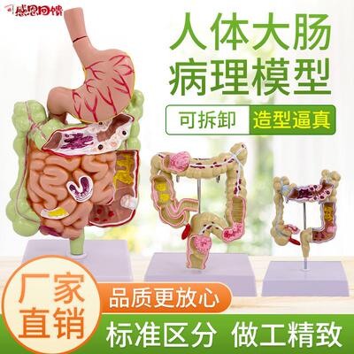 大肠病理模型 肠胃模型 大肠病F变模型 肠道疾病 人体结肠病变模