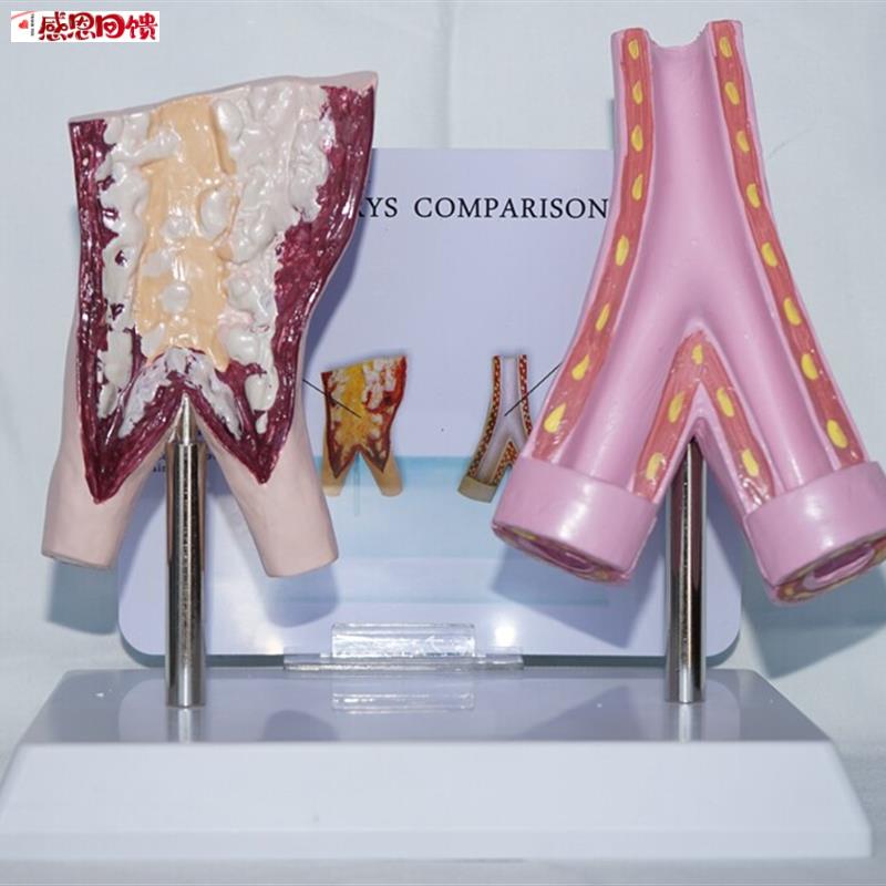 吸烟血管与正常血管比较模型 人体医m用教学健康保健讲解展