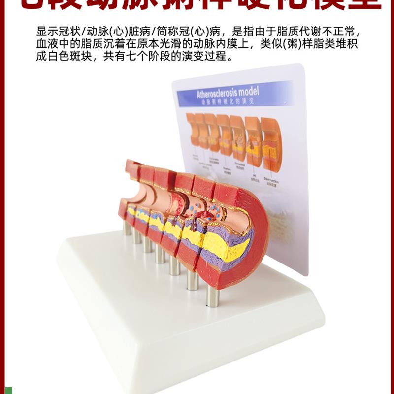 人体心脑血管动脉粥样硬化堵塞模型血栓I血液脂肪病理解剖医学教