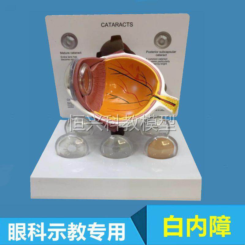 眼球模型白内障晶状体眼睛视力障眼底视网膜眼科F医生沟通医药促