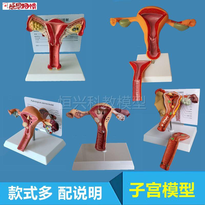 子宫模型健康病变卵巢输卵管辅助生殖医g用解剖妇产康家政医药促