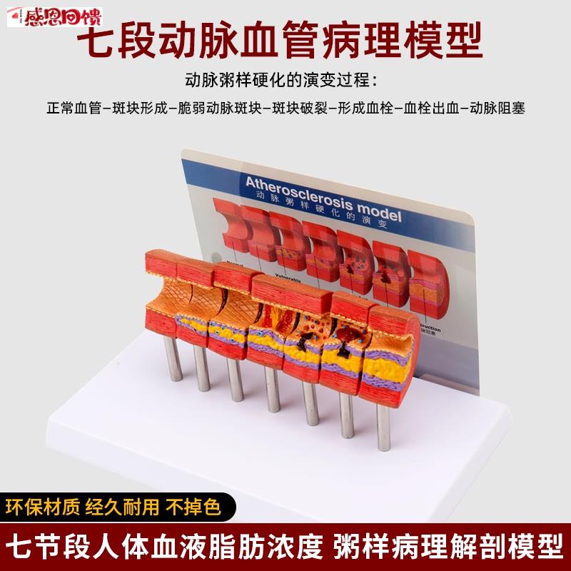仿真人体心脑血管D动脉粥样硬化堵塞模型血栓血液脂肪病理解剖教
