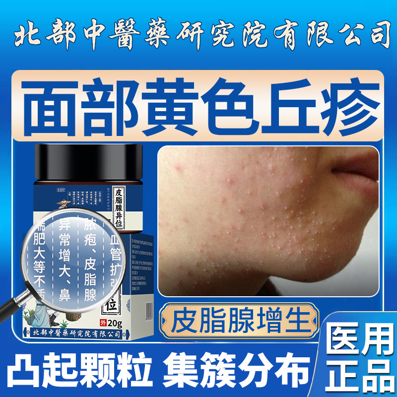 面部皮脂腺增生黄色丘疹额头下巴凸起颗粒密集分布小疙瘩软膏qo