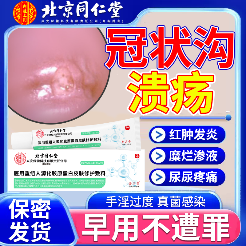 男性冠状沟溃疡糜烂疼痛龟头包皮痒红肿烂溃疡膏过度手淫红斑qod