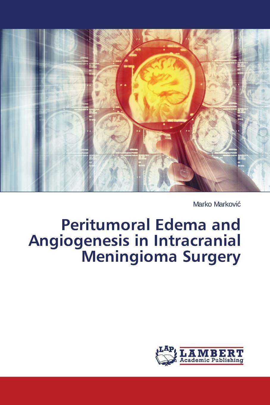预售 按需印刷 Peritumoral Edema and Angiogenesis in Intracranial Meningioma Surgery
