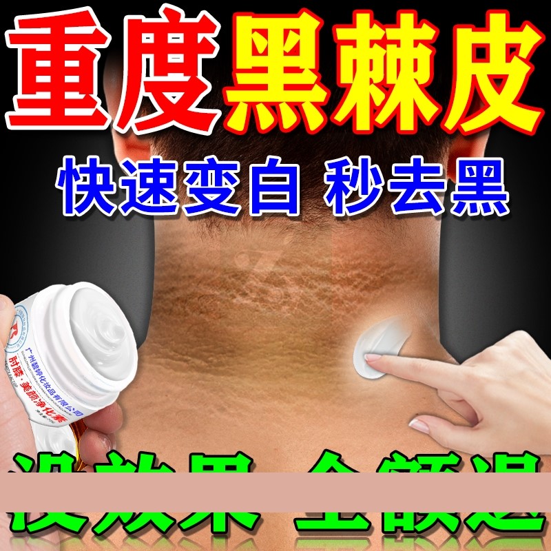 脖子黑色素去除颈部美白霜神器皮肤黑色素沉淀去脖子黑棘皮病药膏