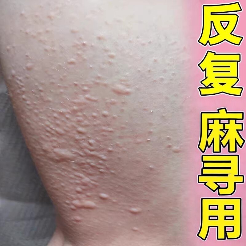 麻过敏疹寻痒断外用药老年人身上起红疙瘩皮肤过敏痒自发性修复膏