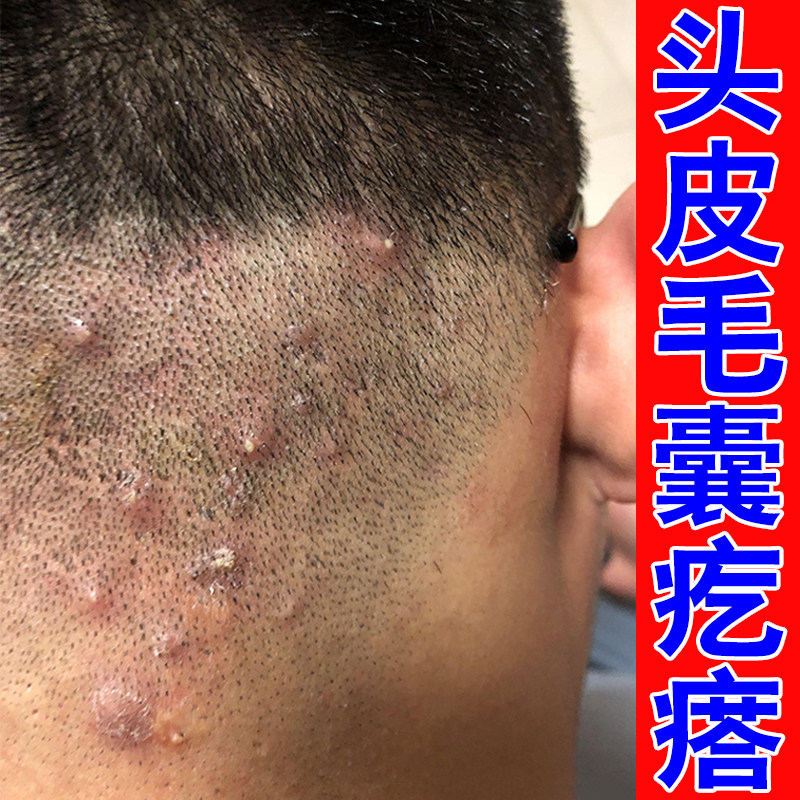 冶头皮长毛囊疙瘩后脑勺长硬块红肿疙瘩毛囊堵塞皮肤感染草本软膏