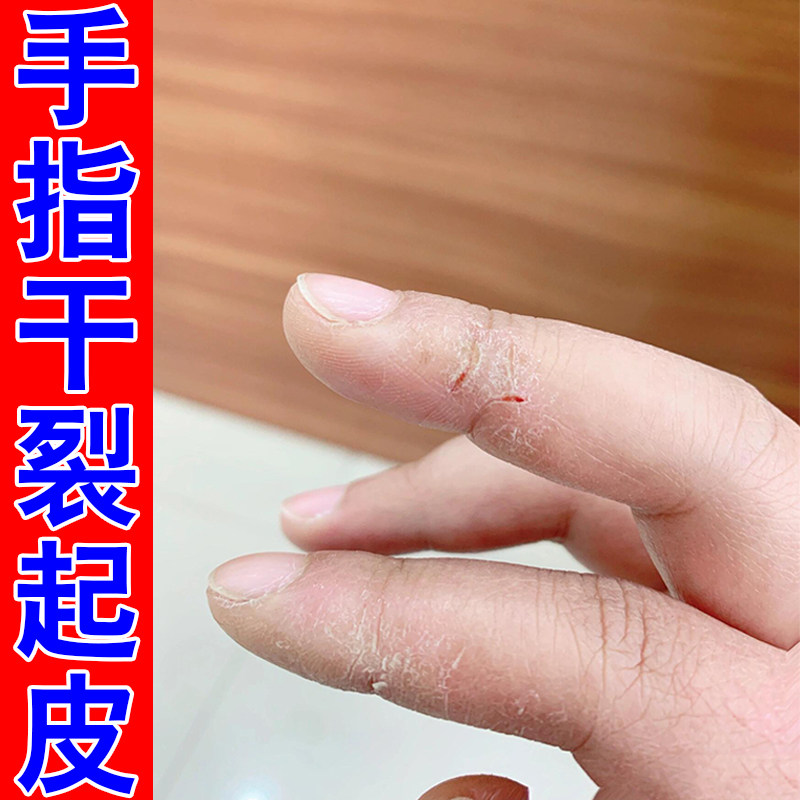 冶手指干燥裂皮肤干燥粗糙换季手足粗糙起皮秋冬天手脱皮粗糙感染