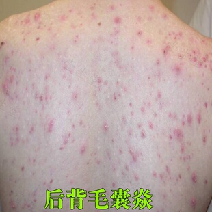 后背毛囊皮肤炎袪豆外用软膏身上长痘痘有痤疮堵塞毛孔痒止药