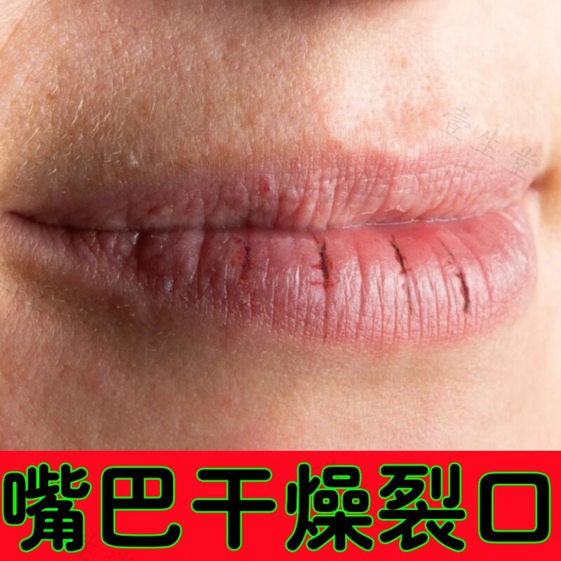 治嘴巴干燥起皮痒外用膏嘴角感染皮肤消毒护理（消）