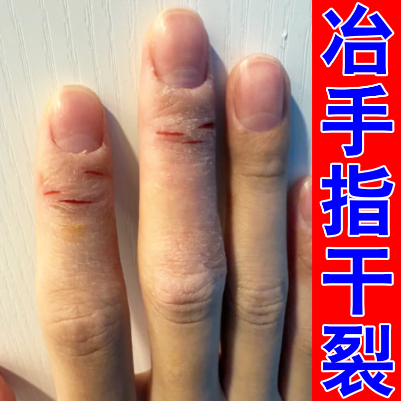 手掌手指头干粗裂糙专用草本保湿软膏换季手足皮肤干燥粗糙起皮屑