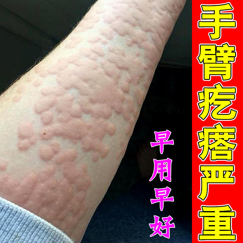 冶手臂长风团疙瘩密集皮肤过敏发痒草本修护软膏身上手臂疙瘩严重
