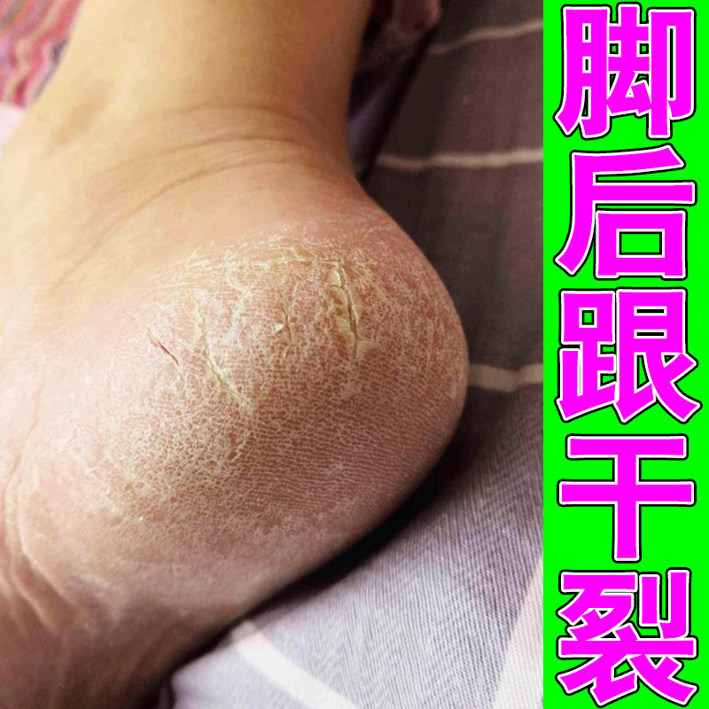冶脚后跟干裂起干皮掉屑草本修护软膏皮肤干燥脚后跟干起皮发痒