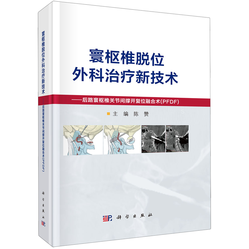 寰枢椎脱位外科治疗新技术:后路寰枢椎关节间撑开复位融合术:PFDF