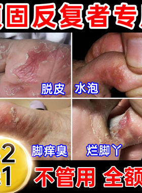 香港药房真菌王脚气膏止脱皮杀真菌感染脚气烂脚趾缝软膏pl
