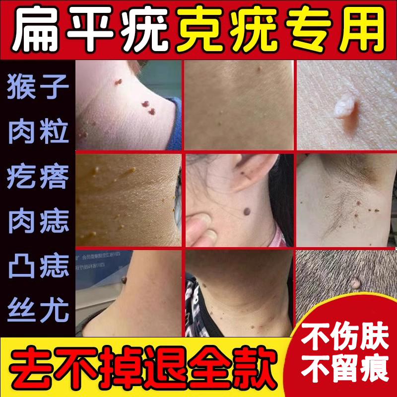 扁平疣面部去除丝状疣治疗祛疣瘊子寻常疣跖疣一抹灵正品专用膏药