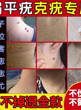 扁平疣面部去除丝状疣治疗祛疣瘊子寻常疣跖疣一抹灵正品专用膏药