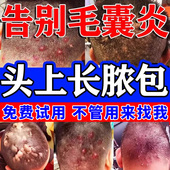 头皮毛囊炎头皮痒有疙瘩溢脂性皮炎专用头上长痘手臂胳膊长疙瘩cc