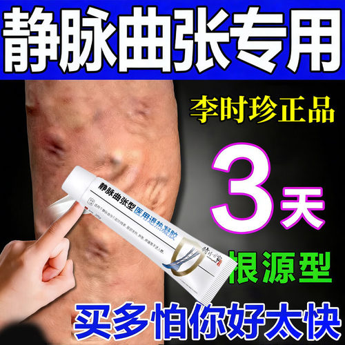 【已冶好19w重症静脉曲张患者】