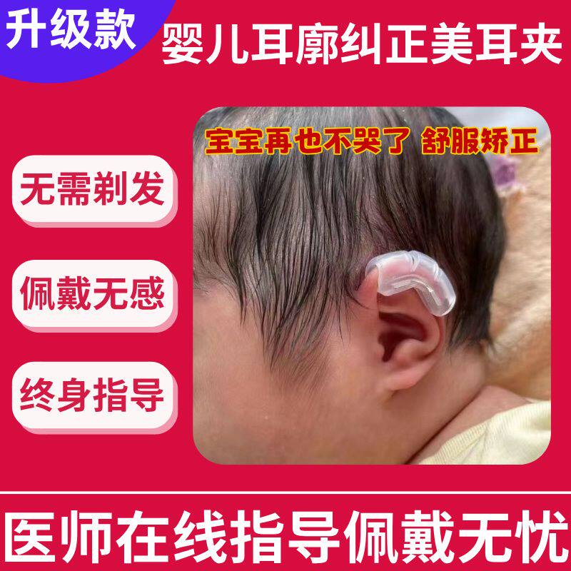 矫正婴儿耳宝宝定型神器