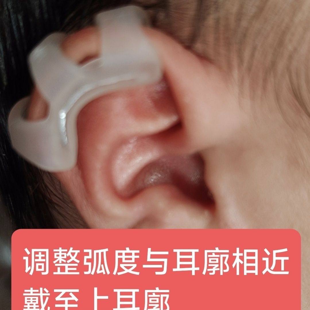耳朵矫正器婴儿耳廓固定