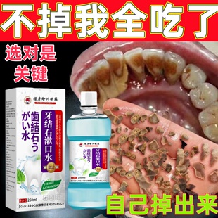 牙结石溶解漱口水除垢清洁牙结石专用神器牙齿污垢美白口臭喷雾剂