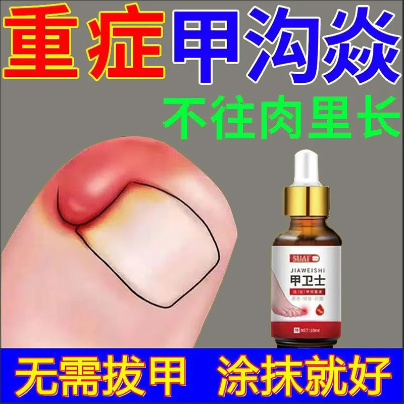 甲沟炎专用特效膏药去甲炎息肉去除嵌甲克星软甲软化剂脱甲神器