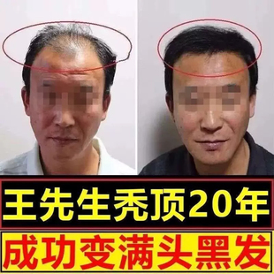 养血生发片正品祺笑除脂脱发治疗溢脂性掉发防脱发去片生发的药