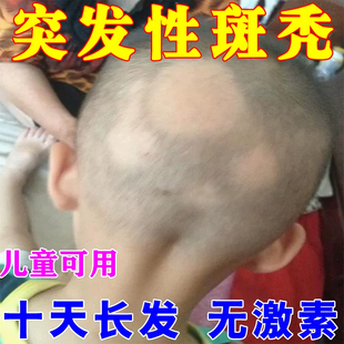 固肾生发丸防脱发治疗掉头发严重吃什么维生素B6片治白头发生发