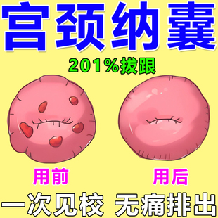 制霉素胶囊康妇特硝呋太尔阴道软胶囊霉菌妇科用药念珠菌炎症