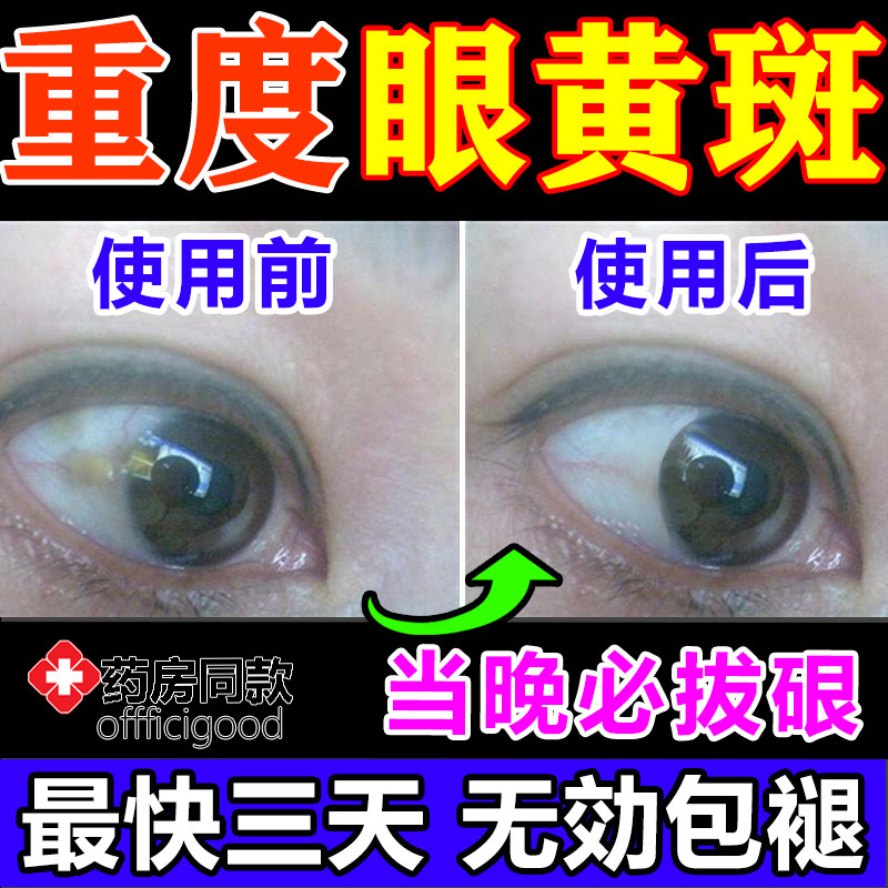 氟米龙滴眼液眼药水进口珍视明明目明缓解视疲劳视力青少年假性近