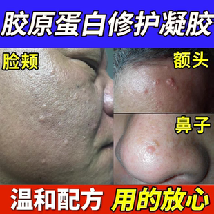 皮脂腺增生囊肿膏脸上起小疙瘩皮肤增生分泌旺盛去鼻子上肉疙瘩BS