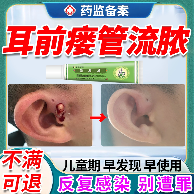 耳前瘘管漏防水贴清理工具红肿鼓包消耳仓发炎流脓中药房同款膏oz