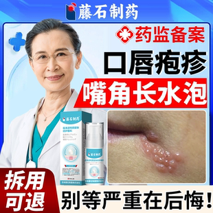 嘴角长水泡口唇疱疹嘴唇单纯疱疹特上火起泡烂嘴角效藤石制药膏EM