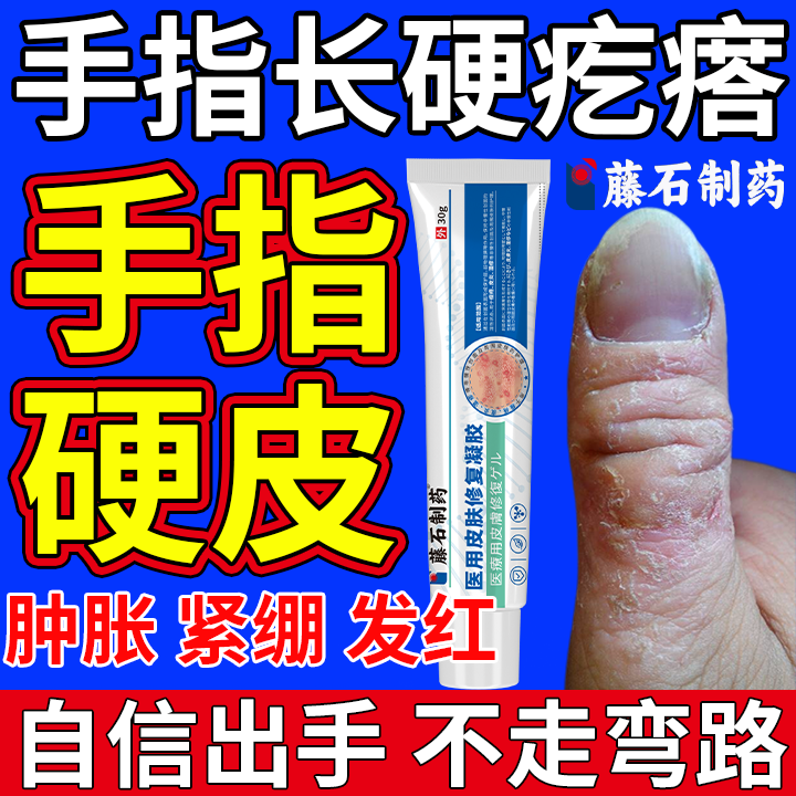 手指硬皮癣皮肤病症去背面干裂角质化医步增厚抗菌剂可搭中药材OZ